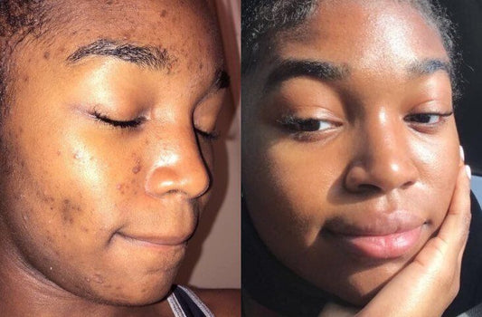 Everything You Need to Know About Hyperpigmentation (And How to Fade It for Good)